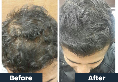 hair-fall